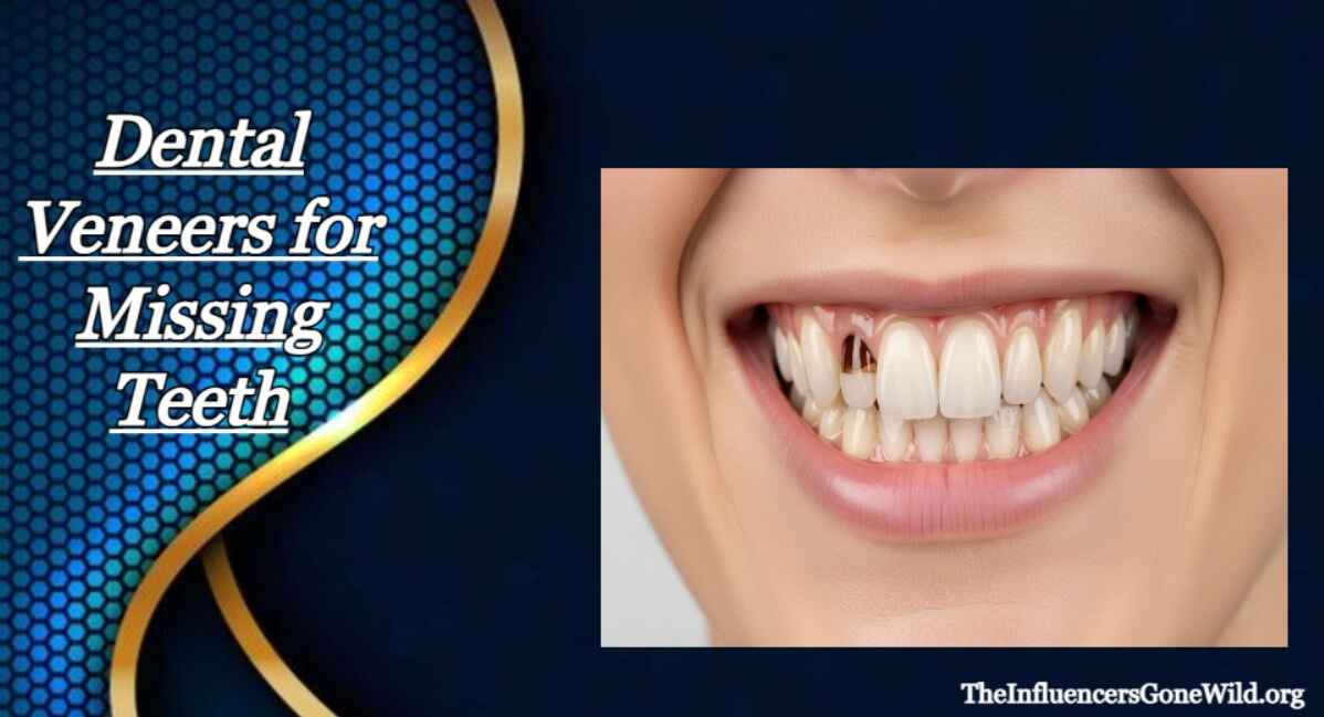 How to Care for Veneers Around Missing Teeth