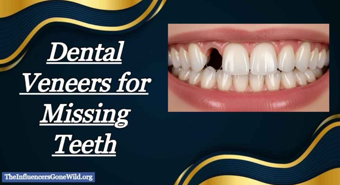 What Are Dental Veneers